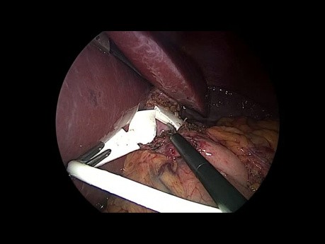Die Umwandlung einer Magenband in eine Roux-en-Y 