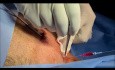 Einrichtung eines Portkatheters für die Chemotherapie