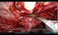 Tipps und Tricks: Roboterassistierte radikale Prostatektomie