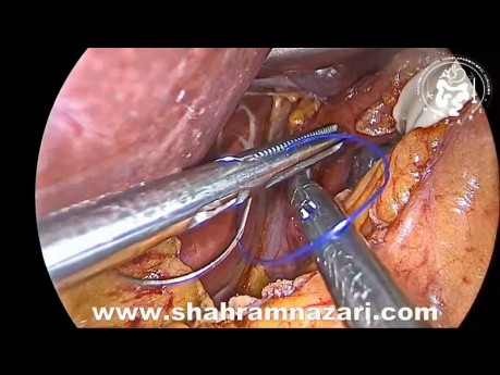 Sleeve-Gastrektomie