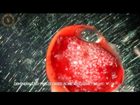 Anhebung des Kieferhöhlenbodens und Implantation in einem mikrochirurgischen Zugang