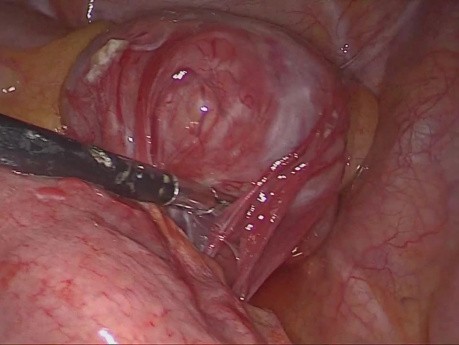 Laparoskopische Resektion des GIST im Jejunum