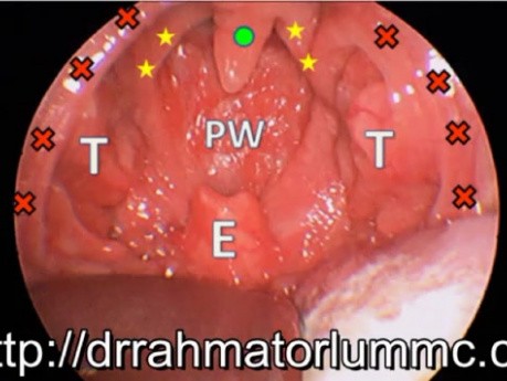 Pädiatrisches obstruktives Schlafapnoe-Syndrom (OSA) - Deutlich verlängerte Uvula und obstruktives Adenoid