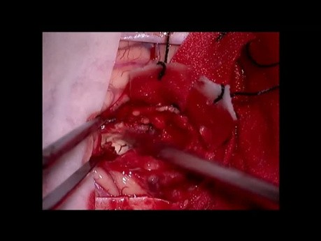 Zerebrale Metastase