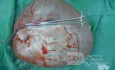 Ovarialzyste 2 (8kg)