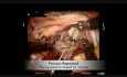 Roboter Assistierte Mitralklappe Reparatur Und Implantation die künstliche Chordae tendineae –engl. Neochords, Rekonstruktion der Herzklappen und des Mitralannulus  mit dem Abschluss des Persistierendes Foramen ovale –PFO und des linken Herzohres.
