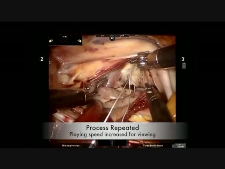 Roboter Assistierte Mitralklappe Reparatur Und Implantation die künstliche Chordae tendineae –engl. Neochords, Rekonstruktion der Herzklappen und des Mitralannulus  mit dem Abschluss des Persistierendes Foramen ovale –PFO und des linken Herzohres.