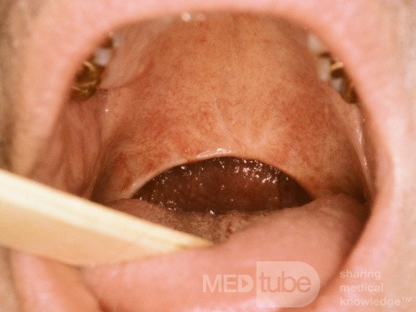Uvulopalatoplastik