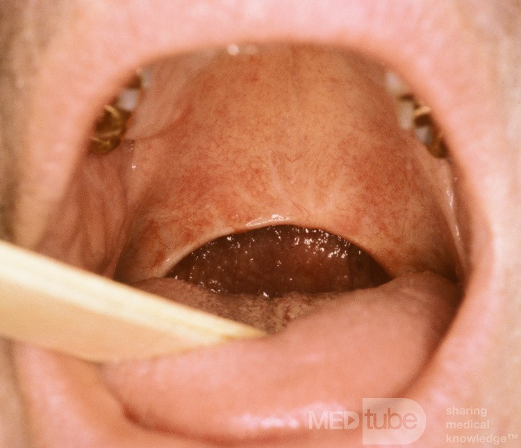 Uvulopalatoplastik