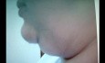 Doppelkinn - plastische Chirurgie
