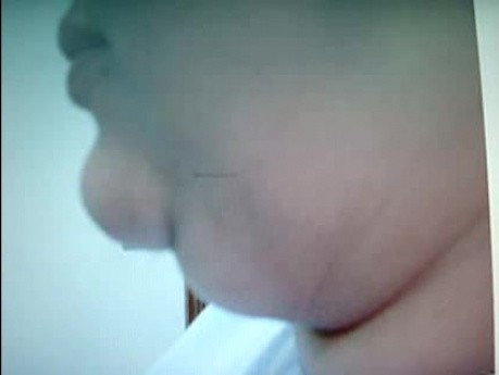 Doppelkinn - plastische Chirurgie
