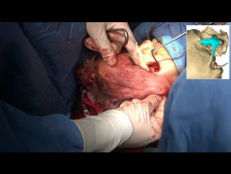 Sekundäre zygomatische Osteotomie und Rekonstruktion mit PEEK-Implantat