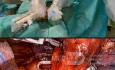 Roboterchirurgie für Lungenkrebs