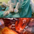 Roboterchirurgie für Lungenkrebs