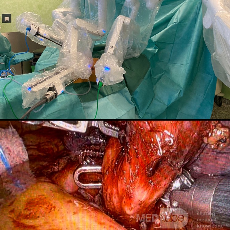 Roboterchirurgie für Lungenkrebs