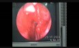 Geschoss in Sinus ethmoidalis