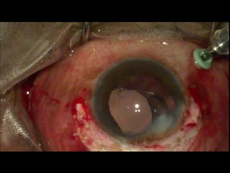 Posteriores Ventrikelimplantat, das an der Sklera befestigt ist