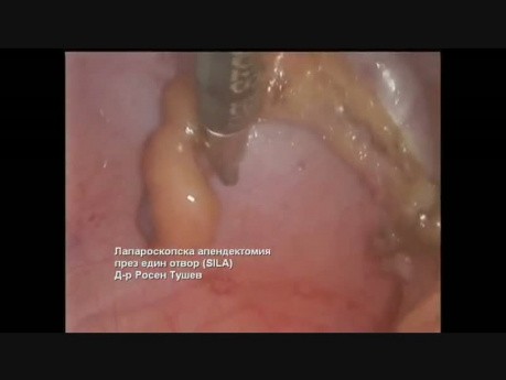 Laparoskopische Appendektomie mit einem Schnitt (SILA)