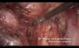 Adnexektomie mit Ureterolyse