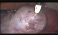 Ovarielles Überstimulationssyndrom bei einer Frau, die sich auf IVF vorbereitet, mit Gangrän im rechten Eierstock