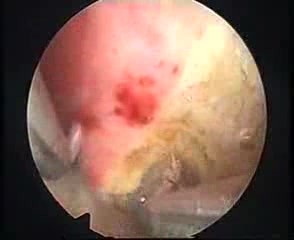 RESECTION MASTER System und Endometriumablation