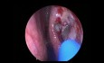 Endoskopische Dacryocystorhinostomy 