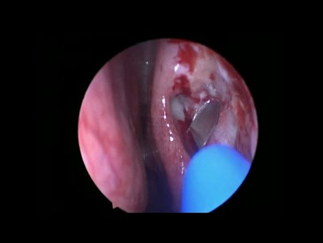 Endoskopische Dacryocystorhinostomy 