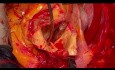 Einsatz von Instrumenten von A bis Z für Aortenbogenchirurgie
