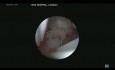 Entfernung der Überreste des Fötus aufgrund einer unvollständigen Fehlgeburt mit einem kalten Messer während der Hysteroskopie