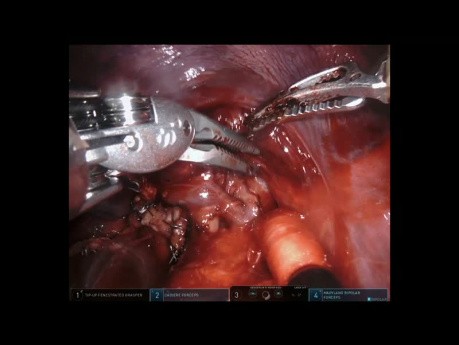 Lobektomie Oberlappen rechts (roboterassistierte Chirurgie)