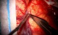 Rechtsseitige frontotemporoparietale Kraniotomie und Resektion eines clinoidalen Meningeoms