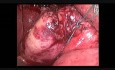 Minilaparoskopische Chirurgie – das zweite „Reduced Port Surgery Forum“