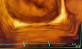 Echokardiographischer Nachweis einer Spaltbildung des vorderen Mitralklappensegels