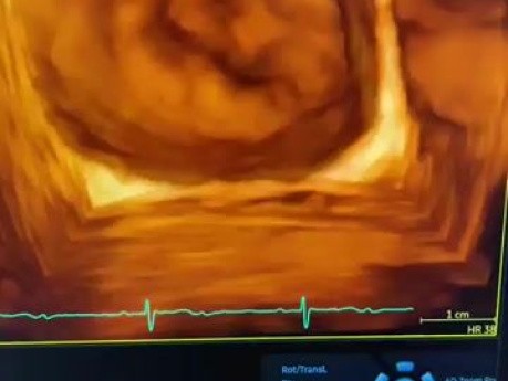 Echokardiographischer Nachweis einer Spaltbildung des vorderen Mitralklappensegels