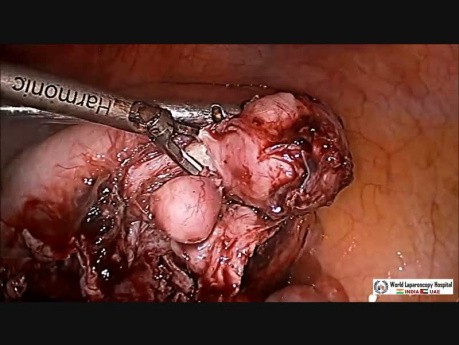 Laparoskopische Myomektomie und Ovarialzystektomie- Uterus myomatosus und Paraovarialzyste