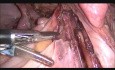 Totale laparoskopische Hysterektomie und bilaterale Salpingo-Oophorektomie - Endometriose