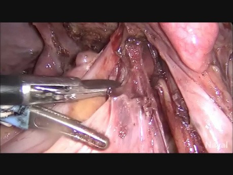 Totale laparoskopische Hysterektomie und bilaterale Salpingo-Oophorektomie - Endometriose