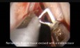 Mikrolappentechnik (MLE) – Angiomatöser Polyp des linken Stimmbandes