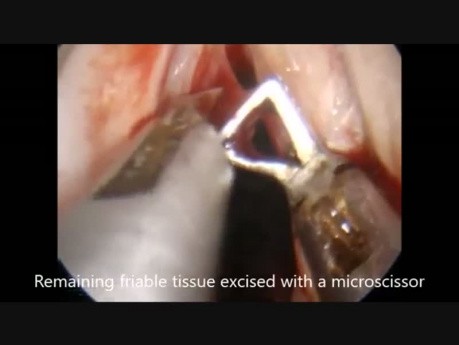 Mikrolappentechnik (MLE) – Angiomatöser Polyp des linken Stimmbandes