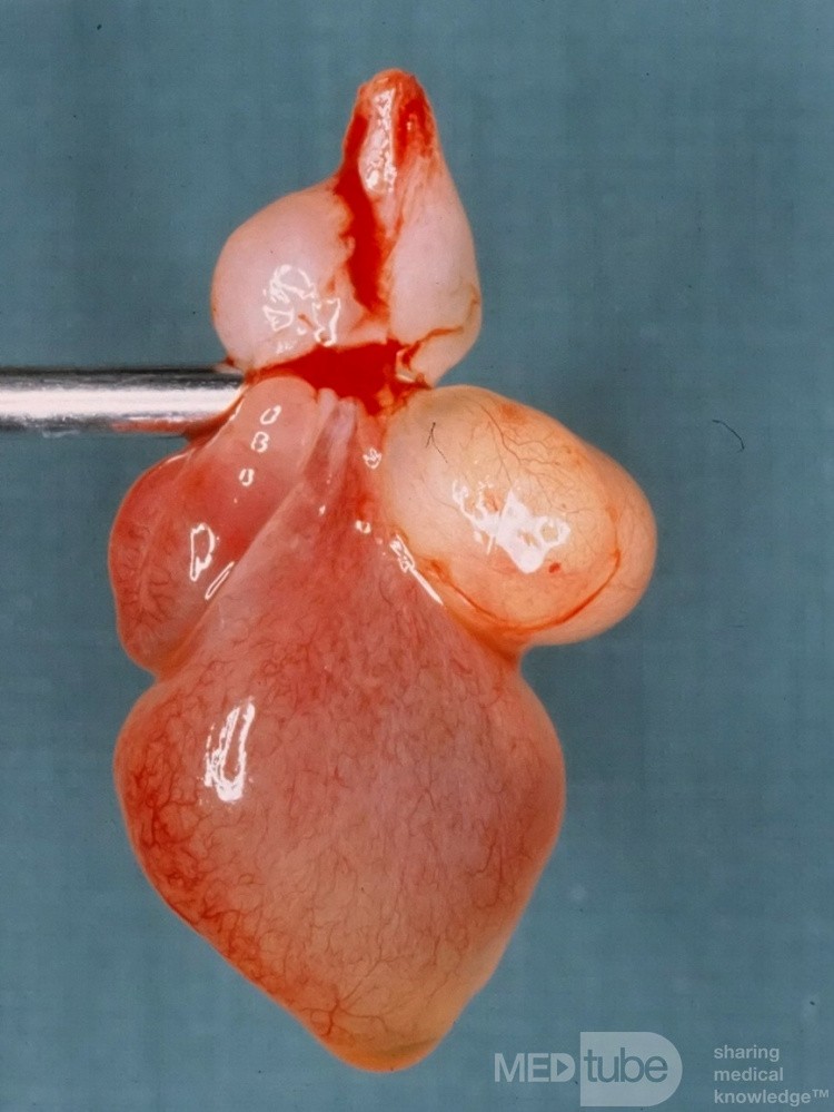 Nasenpolyp mit einer Saugmaschine entfernt