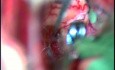Clipping eines A. communicans anterior-Aneurysmas