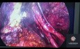 Tiefe Endometriose-Exzision mit Peritonektomie und retrozervikaler Knotenresektion