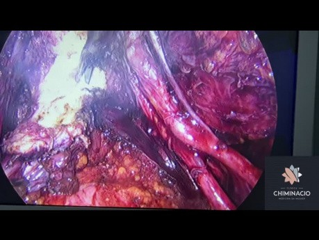 Tiefe Endometriose-Exzision mit Peritonektomie und retrozervikaler Knotenresektion