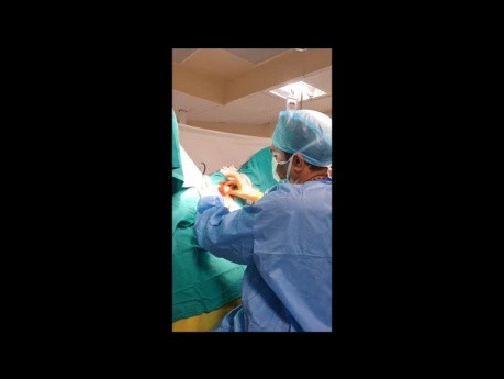 Analfistel mit Ausbreitung im Skrotum