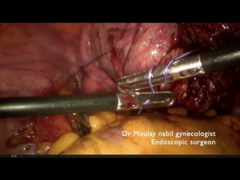 Miomectomy