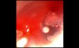 Subglottische Stenose