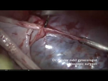 Die Behandlung von einer großen Ovarialzyste im Kontext der Unfruchtbarkeit