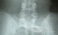 Spina bifida occulta