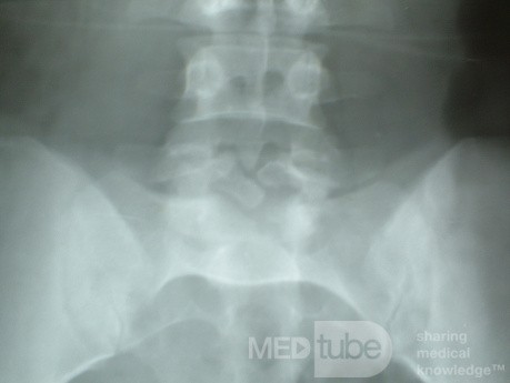 Spina bifida occulta