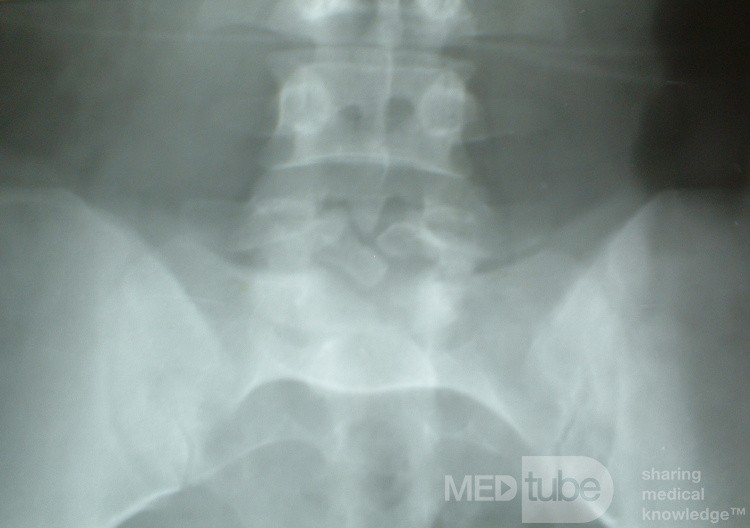 Spina bifida occulta